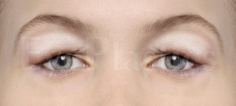 Cosmetic eyelid surgery, Blepharoplasty, Eyelift